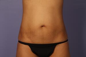 Tummy Tuck Before & After Image