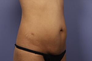 Tummy Tuck Before & After Image