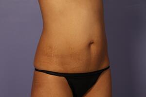 Tummy Tuck Before & After Image