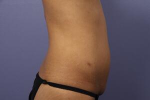 Tummy Tuck Before & After Image