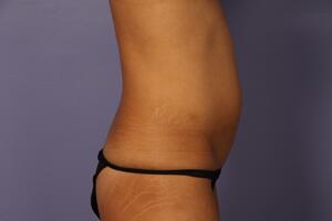 Tummy Tuck Before & After Image