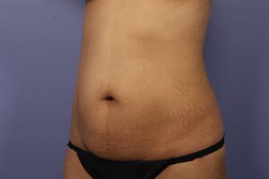 Tummy Tuck Before & After Image