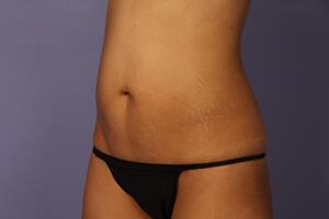 Tummy Tuck Before & After Image