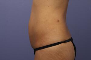 Tummy Tuck Before & After Image