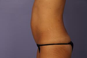 Tummy Tuck Before & After Image