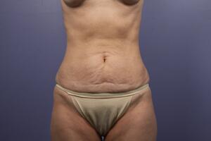 Tummy Tuck Before & After Image