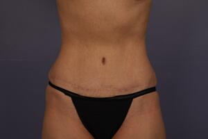 Tummy Tuck Before & After Image