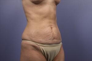 Tummy Tuck Before & After Image