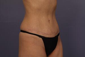 Tummy Tuck Before & After Image