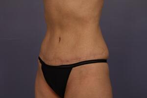 Tummy Tuck Before & After Image