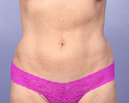 Tummy Tuck Before & After Image