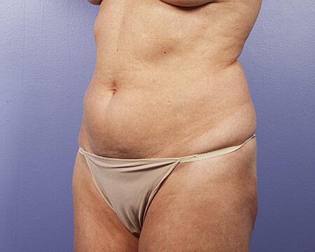 Tummy Tuck Before & After Image