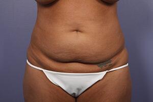 Tummy Tuck Before & After Image