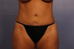 Tummy Tuck Before & After Image