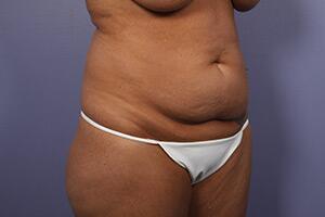 Tummy Tuck Before & After Image