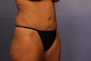 Tummy Tuck Before & After Image