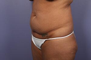 Tummy Tuck Before & After Image