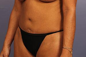 Tummy Tuck Before & After Image