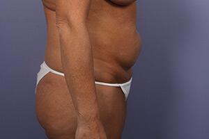 Tummy Tuck Before & After Image