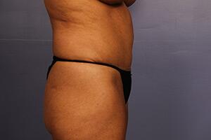 Tummy Tuck Before & After Image