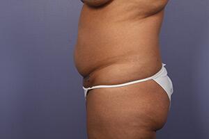 Tummy Tuck Before & After Image