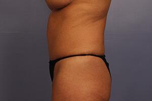 Tummy Tuck Before & After Image