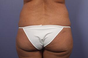 Tummy Tuck Before & After Image