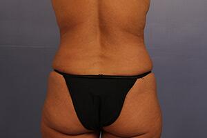 Tummy Tuck Before & After Image