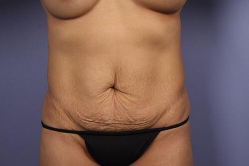 Tummy Tuck Before & After Image