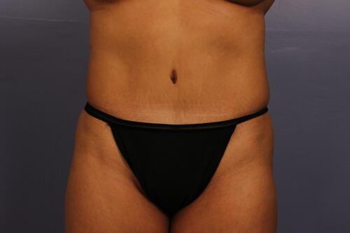 Tummy Tuck Before & After Image