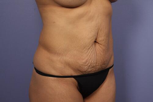 Tummy Tuck Before & After Image