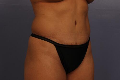 Tummy Tuck Before & After Image