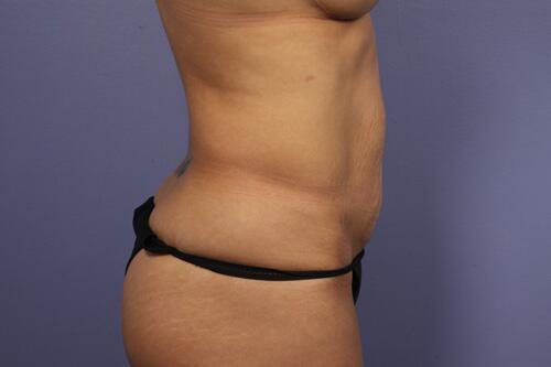 Tummy Tuck Before & After Image