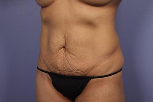 Tummy Tuck Before & After Image