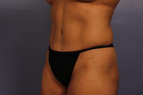 Tummy Tuck Before & After Image