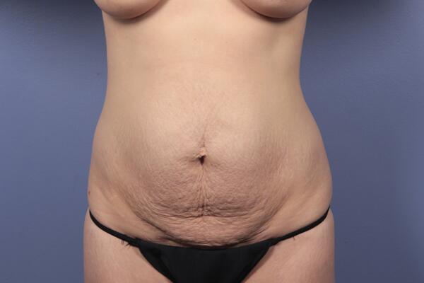 Tummy Tuck Before & After Image