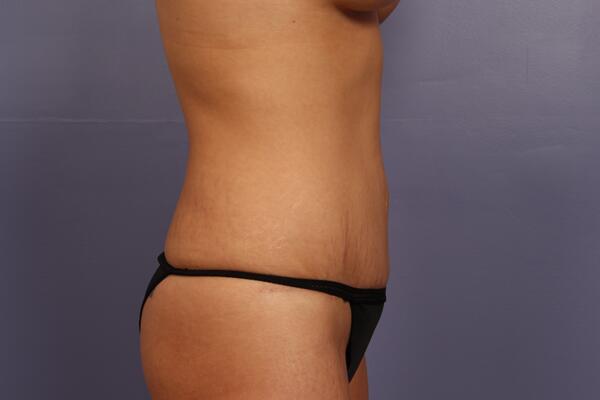 Tummy Tuck Before & After Image