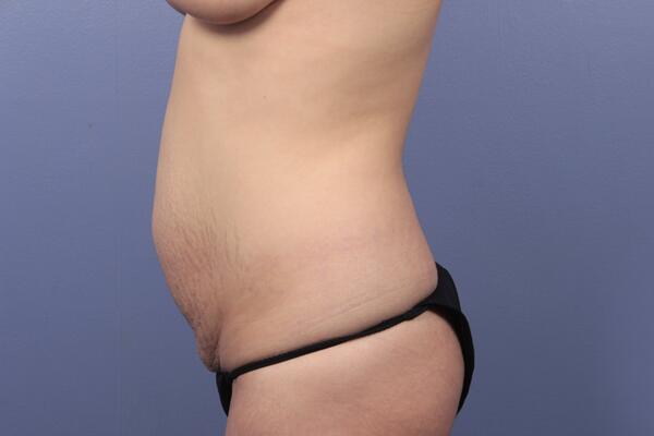 Tummy Tuck Before & After Image