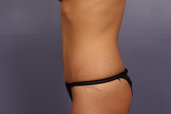 Tummy Tuck Before & After Image