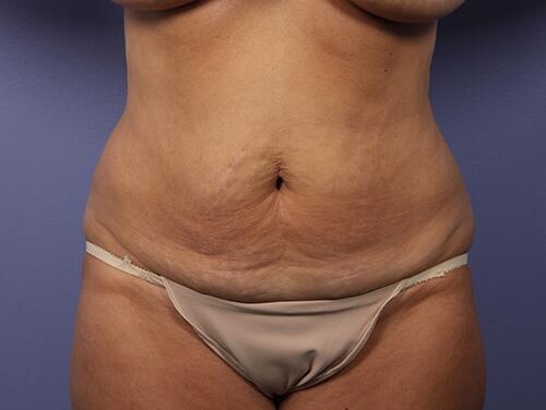 Tummy Tuck Before & After Image