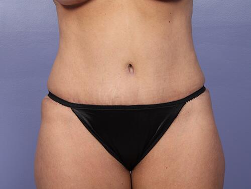 Tummy Tuck Before & After Image