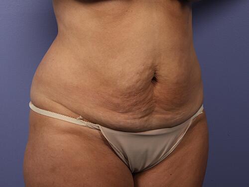 Tummy Tuck Before & After Image