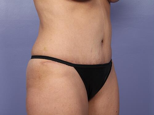 Tummy Tuck Before & After Image