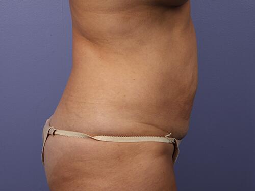 Tummy Tuck Before & After Image