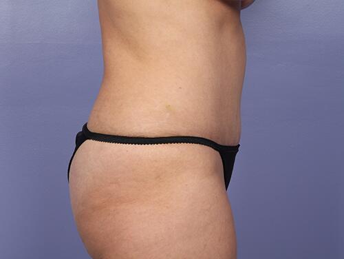 Tummy Tuck Before & After Image