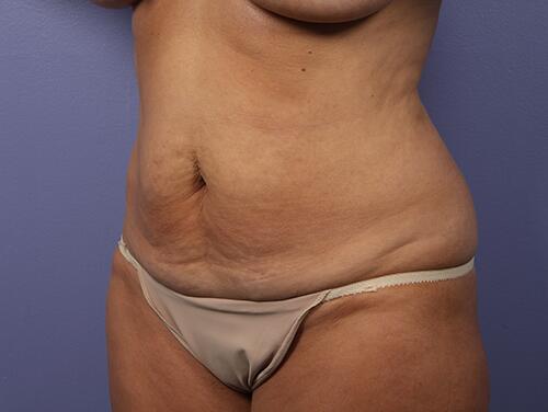 Tummy Tuck Before & After Image