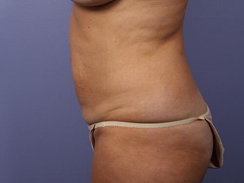 Tummy Tuck Before & After Image