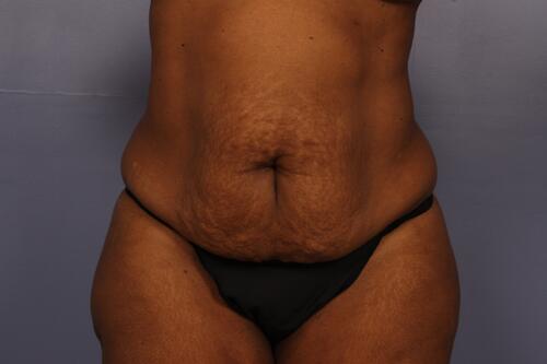 Tummy Tuck Before & After Image