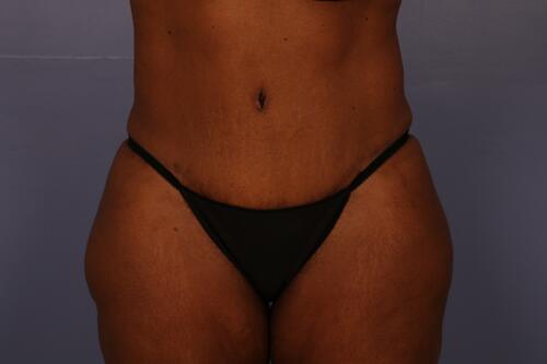 Tummy Tuck Before & After Image