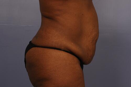 Tummy Tuck Before & After Image